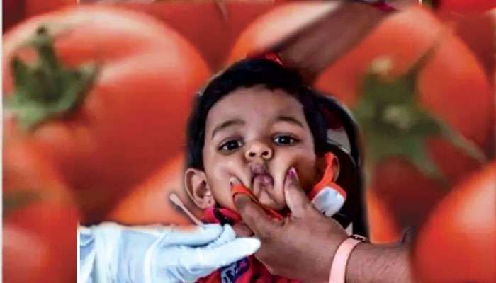 Tomato Flu: চোখ রাঙাচ্ছে Tomato Flu, শিশুদের এই রোগ নিয়ে আতঙ্কে একাধিক রাজ্য