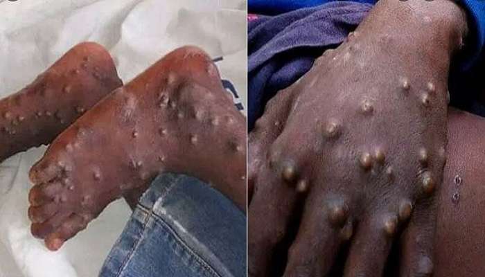 Monkeypox: নেই ওষুধ, ভরসা একমাত্র এই ভ্যাকসিন! &#039;ভয়ঙ্কর&#039; মাঙ্কিপক্সের মারণক্ষমতা কতখানি