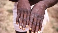  Monkeypox: নয়া বিপদ সঙ্কেত? মাঙ্কি পক্সকে মহামারি ঘোষণা বিশ্ব স্বাস্থ্য সংস্থার