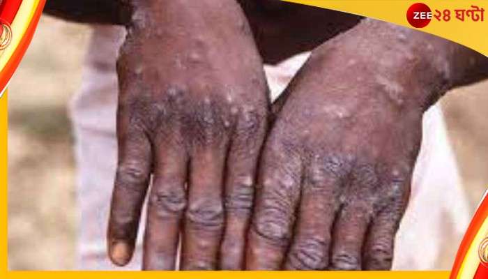 Monkeypox: মাঙ্কি পক্সও হানা দিল ভারতে, প্রথম কেস কেরালায়