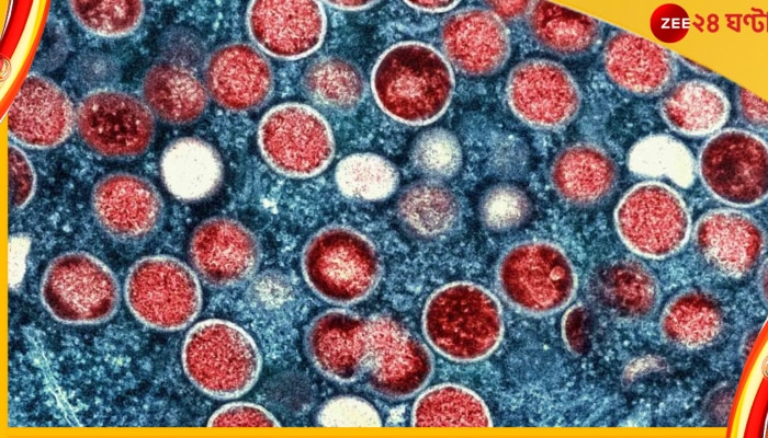 Monkeypox Covid-19 HIV: বিশ্বে প্রথম! একই ব্যক্তি একসঙ্গে মাঙ্কিপক্স, কোভিড, এইচআইভি তিন ভাইরাসেই আক্রান্ত 