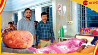 তলপেটের যন্ত্রণায় ছটফট করছিলেন যুবক, অস্ত্রোপচারে বেরিয়ে এল ৫০০ গ্রাম ওজনের পাথর!