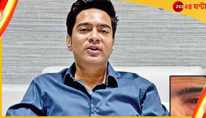 Abhishek Banerjee:   চিকিৎসার জন্যই বাইরে, অভিষেকের রক্তাক্ত চোখের ছবি প্রকাশ্যে!