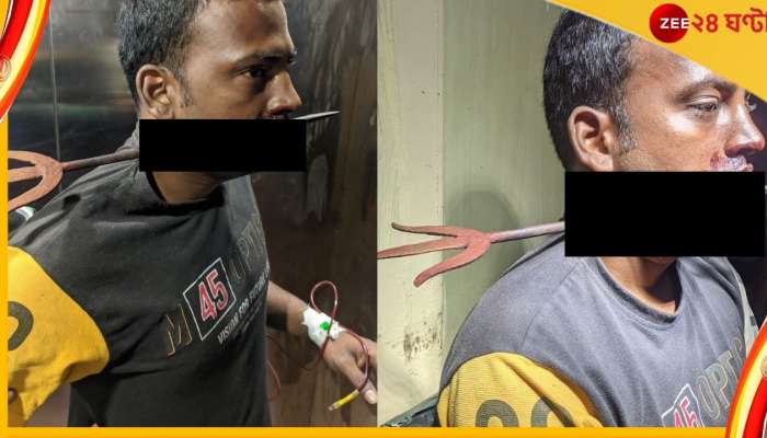 NRS: গলায় বিঁধে ত্রিশূল, এনআরএসে অস্ত্রোপচারে বাঁচল প্রাণ!