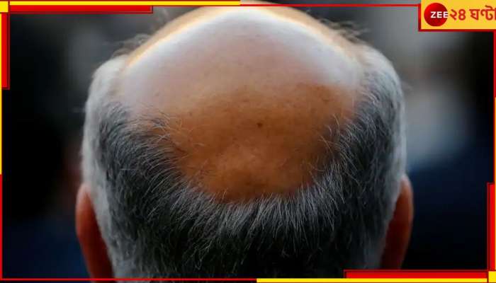 Bald counts as sexual harassment: অফিসে কাউকে টেকো বলাও যৌন নিগ্রহের সমতুল্য অপরাধ