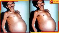 টানা ৩ দশক বয়ে বেড়াচ্ছিলেন যমজকে, নাগপুরের সঞ্জয়কে দেখে তাজ্জব চিকিত্সকেরা