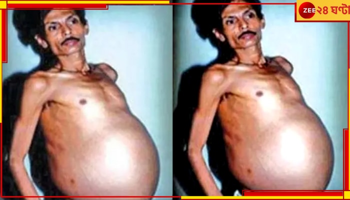 Nagpur Pregnanat Man: টানা ৩ দশক বয়ে বেড়াচ্ছিলেন যমজকে, নাগপুরের সঞ্জয়কে দেখে তাজ্জব চিকিত্সকেরা