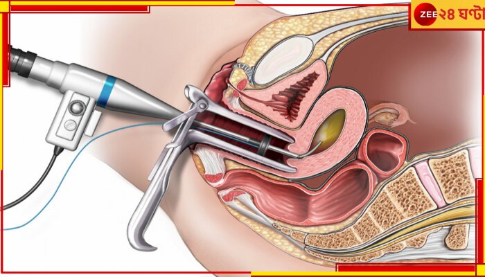 Hysteroscopy: জরায়ুর অন্দরে জটিলতার খোঁজে অত্যাধুনিক হিস্টেরোস্কোপি