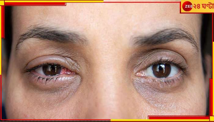 Conjunctivitis: চোখে এই অসুবিধা হওয়ার অর্থই কনজাংটিভাইটিস? কী উপায়ে আটকানো যাবে এই রোগ? 