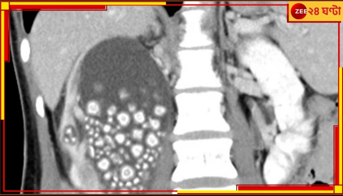 Kidney Stone: জল তেষ্টা পেলেই বাবল টি, পেট থেকে বেরোল ৩০০ পাথর