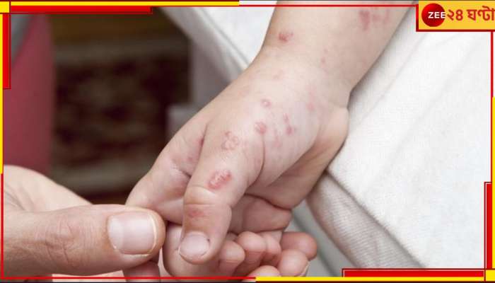 Monkeypox: এসে গেল ঘরে ঘরে পক্স হওয়ার সময়! জেনে নিন, এই রোগের হাত থেকে বাঁচবেন কীভাবে...