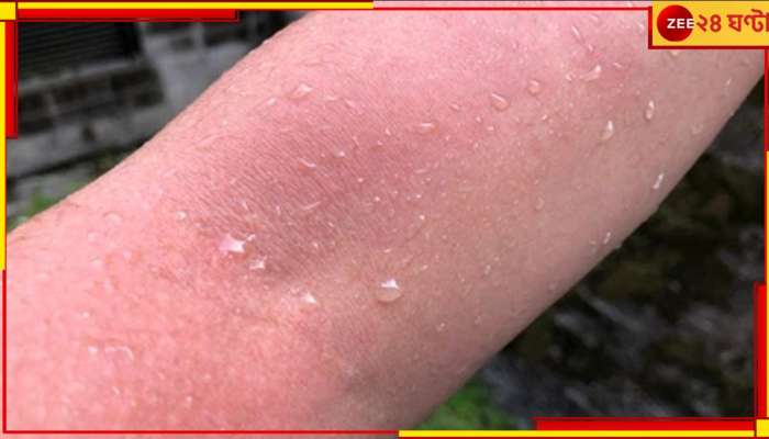 Aquagenic Urticaria: জল মানেই জীবন নয়, বরং উলটে বিপদ! ভয়ে ১০ বছর স্নান করেননি এই তরুণী...