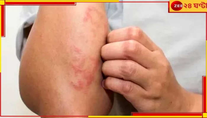 Eczema Tips: প্যাচপ্যাচে গরমে খচখচ করে না চুলকে একজিমার হাত থেকে বাঁচুন! বিশেষজ্ঞদের পরামর্শ...