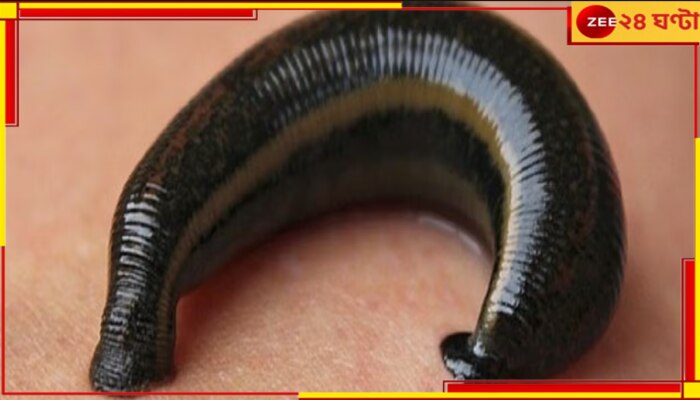 Leech found inside nose: ভয়াবহ! চুপ করে ভিতরে বসে চুষে খাচ্ছে রক্ত, কী ওটা? 