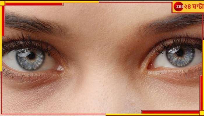 Cholesterol in Eyes: চোখের চারিদিকে অদ্ভুত মাংসপিণ্ড! এই ভয়ঙ্কর লক্ষণই ডেকে আনবে...