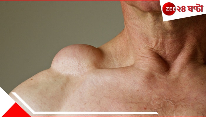 Fat Lump | Lipoma: ঘাড়ের উপরে ফুলে উঠেছে কোনও লাম্প! আয়ুর্বেদে রয়েছে মোক্ষম মুক্তির উপায়... Fat Lump | Lipoma: ঘাড়ের উপরে ফুলে উঠেছে কোনও লাম্প! আয়ুর্বেদে রয়েছে মোক্ষম মুক্তির উপায়...