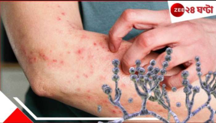 Deadly Fungal Infection: মৃত্যুমুখে পড়তে পারেন ১০ লাখ! শরীরে বাসা বাঁধা ভয়ংকর ছত্রাক আপনাকে 'খেয়ে নিচ্ছে' ভিতর থেকে...