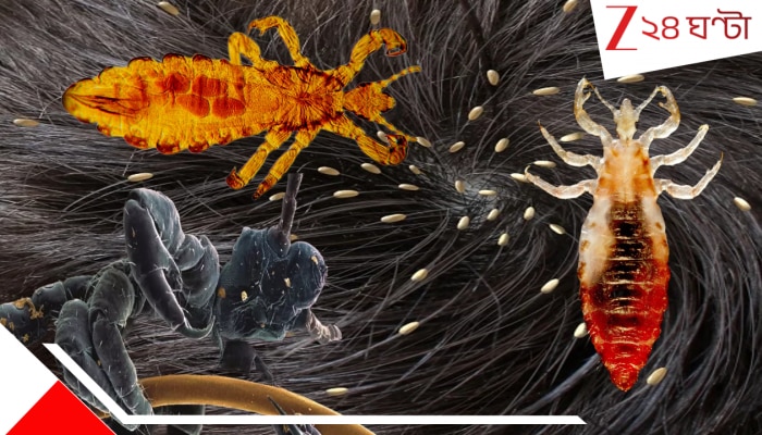 Deadliest Head Lice: উকুনই খুনি? সামান্য মাথার পোকা খেয়ে ফেলতে পারে একটা গোটা মানুষকে? রক্তচোষা রাক্ষসের আতঙ্কে কাঁপছে দেশ...