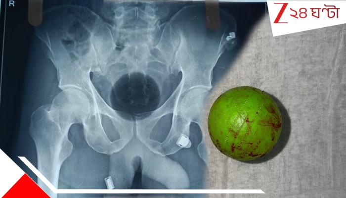 NRS Medical Collage: মলাশয়-বৃহদন্ত্রের মাঝে আটকে আস্ত ক্রিকেট বল, অবিশ্বাস্য কায়দায় বের করা হল NRS-এ